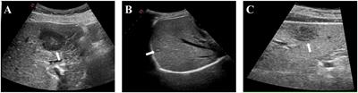 Application and evaluation of hydrodissection in microwave ablation of liver tumours in difficult locations